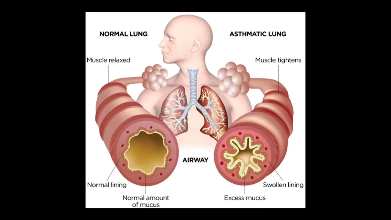 The Connection Between Asthma Attacks and Chronic Sinusitis